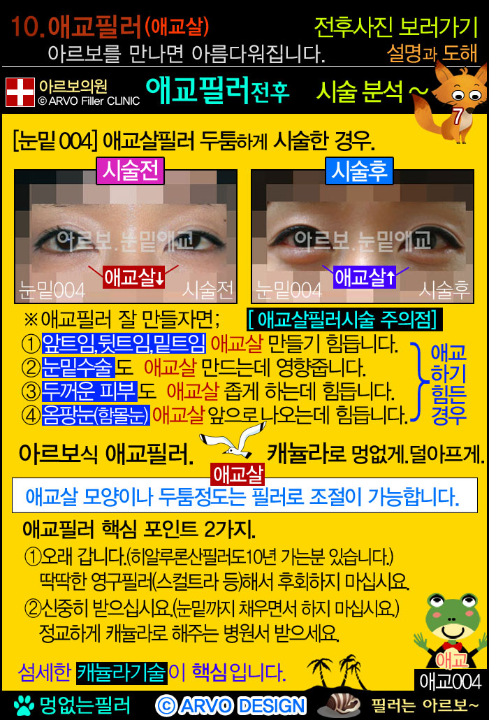 턱끝필러,비대칭턱끝교정,브이라인,턱끝필러,브이라인필러,브이라인턱필러,턱필러,브이라인턱