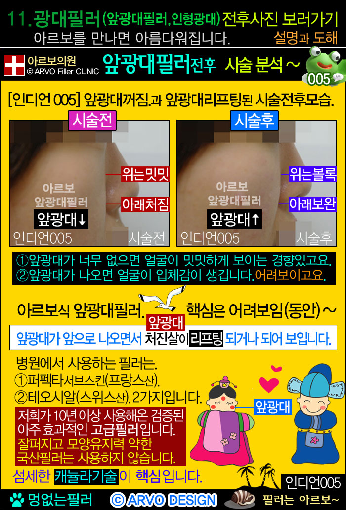 턱선필러,턱선패임필러,턱라인필러,브이라인,브이라인필러,브이라인턱,턱선필러전후설명