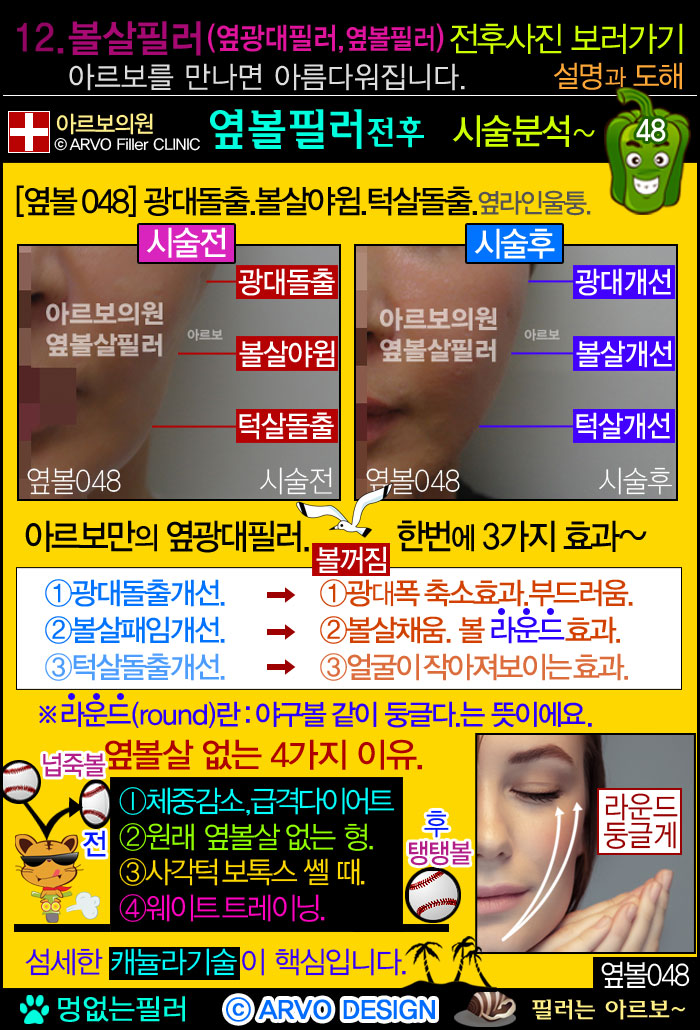 비순각필러,인중필러,고양이필러,고양이수술,고양이시술 ,고양이필러효과,코기둥,인중