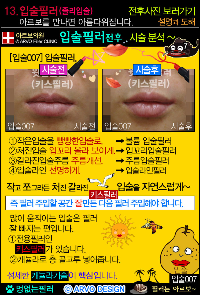 돌출입필러3가지,돌출입필러,쁘띠양악필러,고양이필러,턱끝필러,쁘띠양악필러전후설명