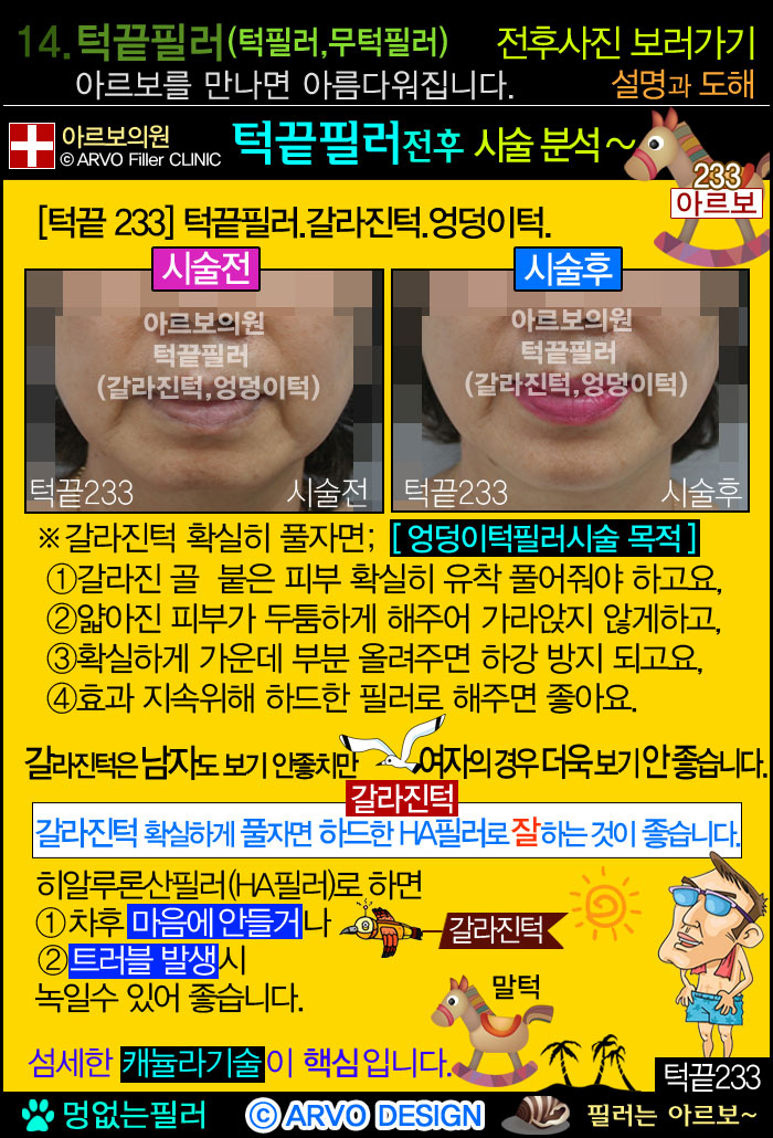 코필러,콧대필러,코끝필러,코필러전후설명,매부리코,새부리코,매부리코필러
