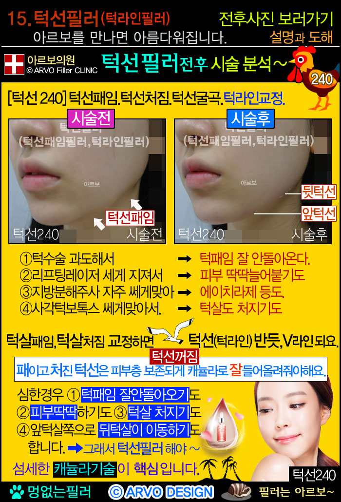 입술전용필러,입술필러,아랫입술교정정도,아래입술필러 볼륨2타입