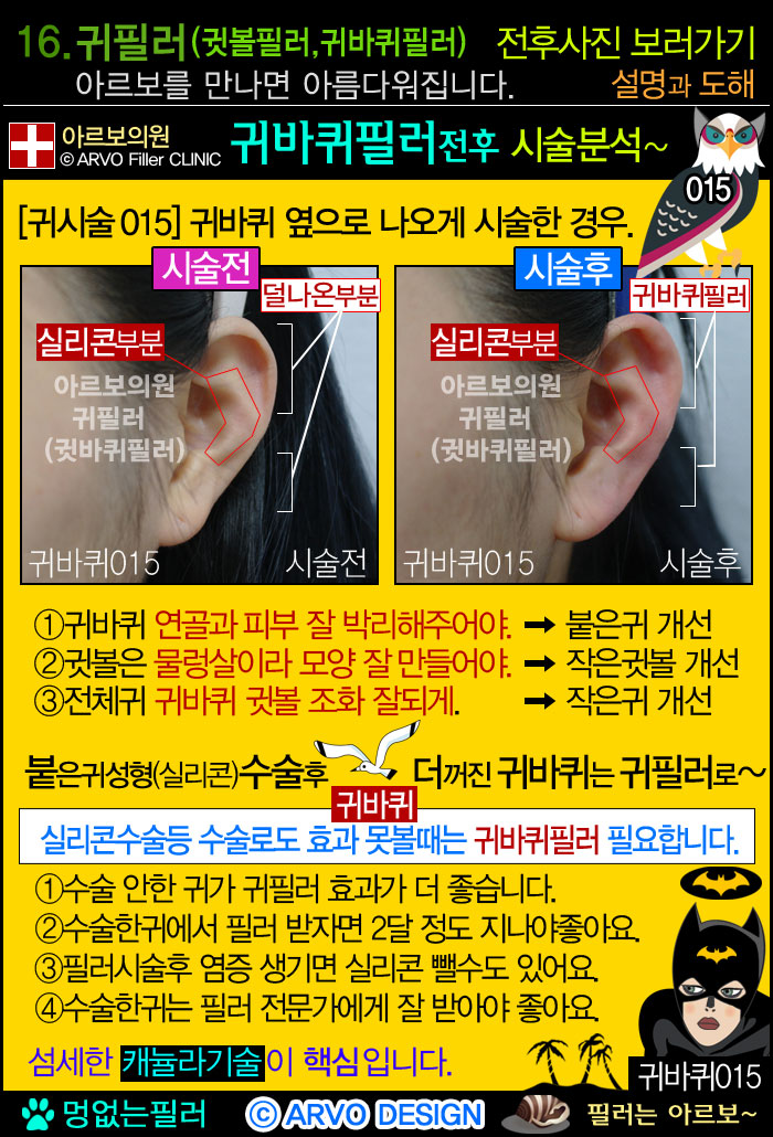 애교필러,애교살필러,눈밑필러,다크서클,다크써클,애교필러주의점2가지