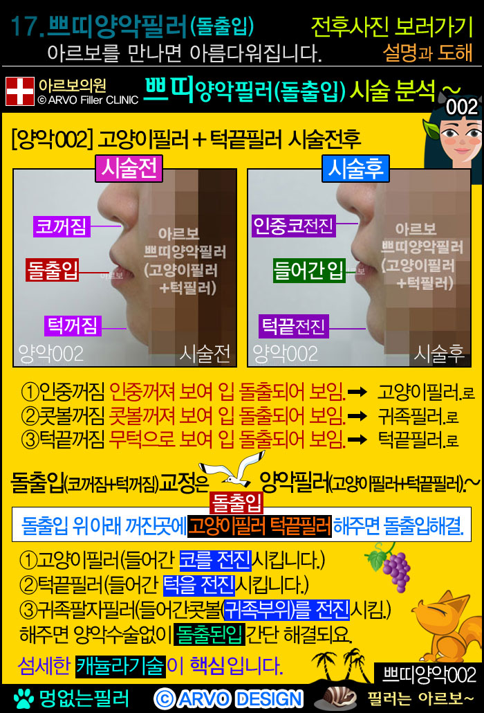 붙은귀,누운귀,실리콘귀성형,패인귀,귀패임,둥근귀귀관상,귀성형,귀바퀴필러,귀필러,귓바퀴필러,아르보의원