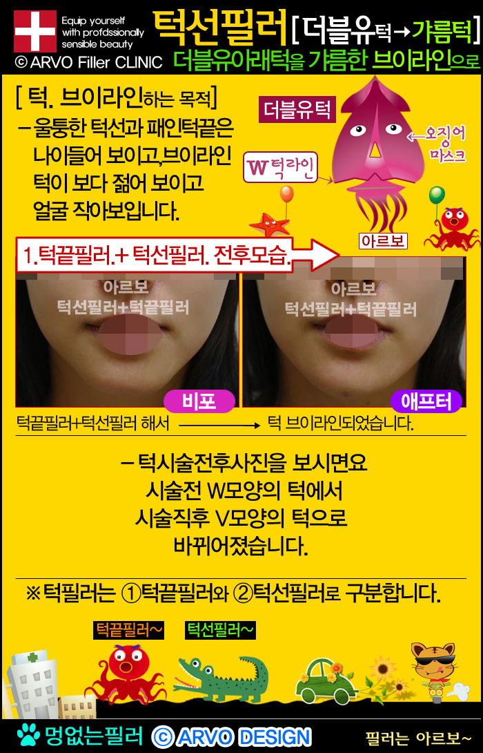 브이라인턱필러,브이턱필러,턱끝필러,턱선필러,브이라인,턱필러,동안턱필러,턱라인브이라인턱