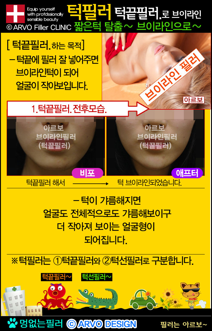 턱필러,턱끝필러,턱선필러,브이라인필러,브이라인턱필러,브이라인턱,하드필러턱필러,아르보의원턱필러