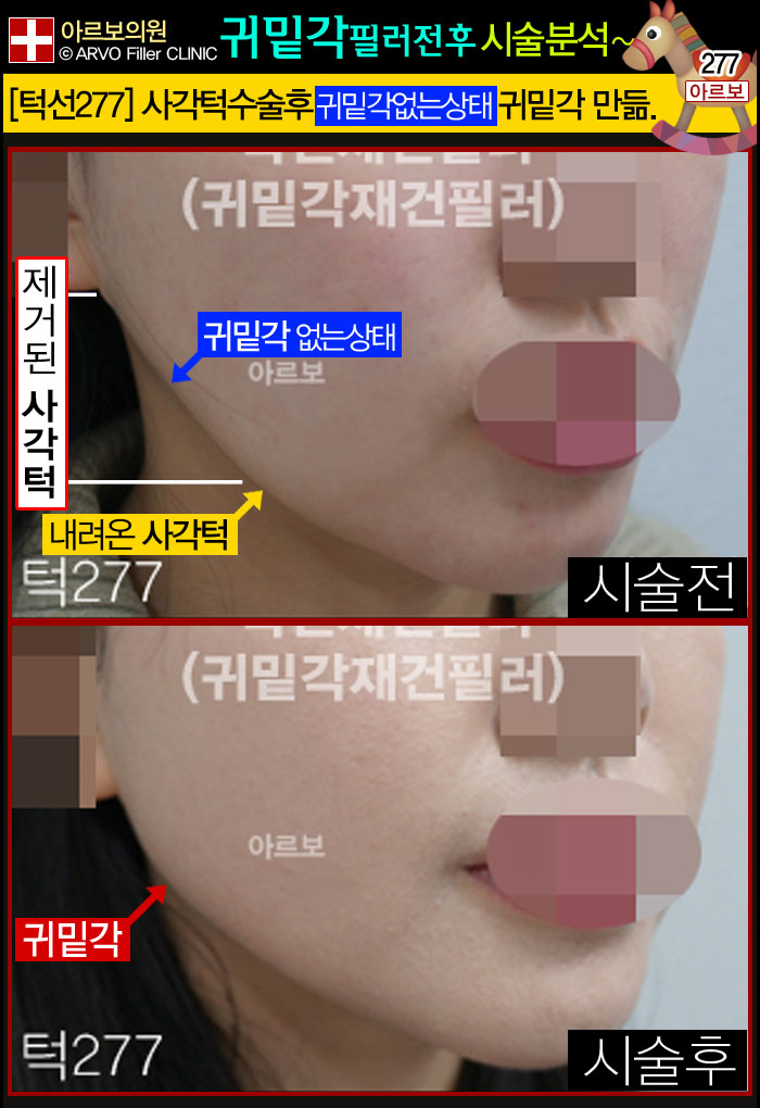 턱선필러,턱선패임필러,턱라인필러,사각턱선필러,턱재건필러,귀밑턱필러,사각턱수술필러
