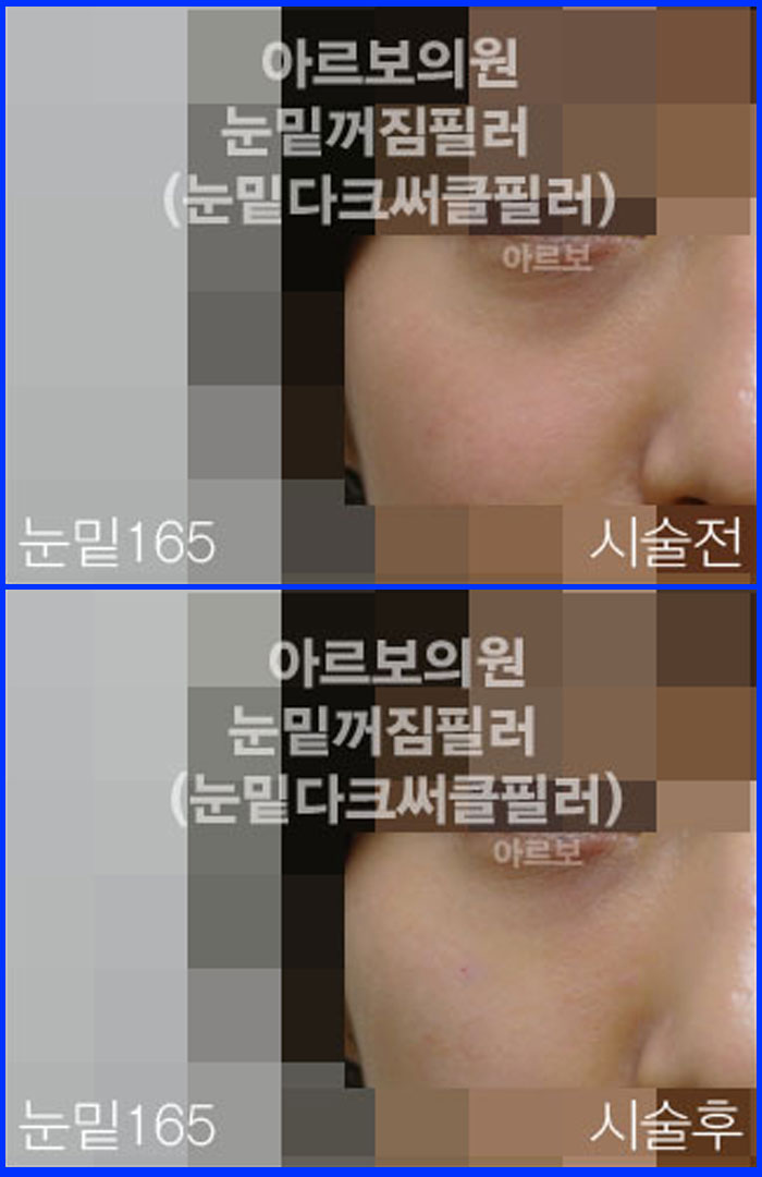 눈밑필러,눈밑꺼짐,다크써클
