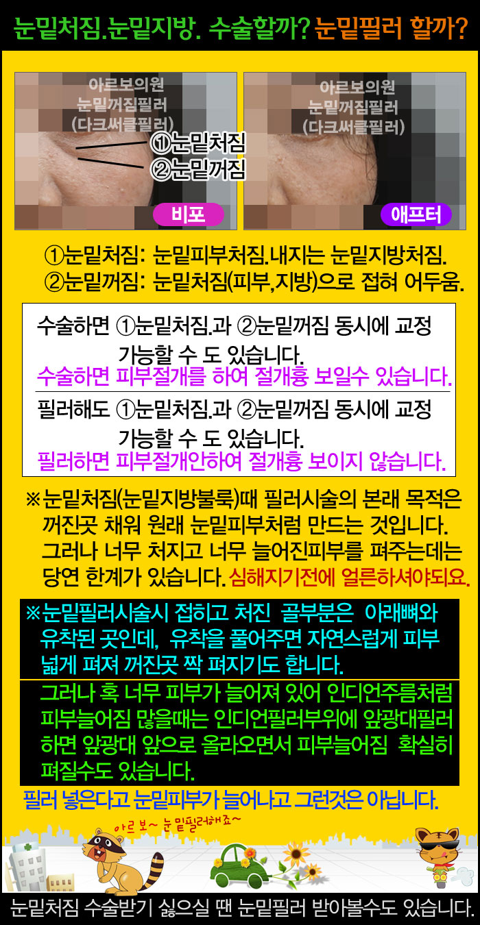 눈밑처짐 수술할까,눈밑처짐 필러할까,눈밑꺼짐유착박리