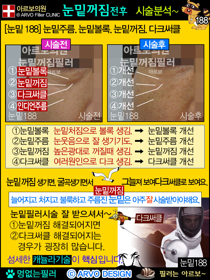 남자눈밑꺼짐,남자눈밑필러,눈밑꺼짐필러188-2