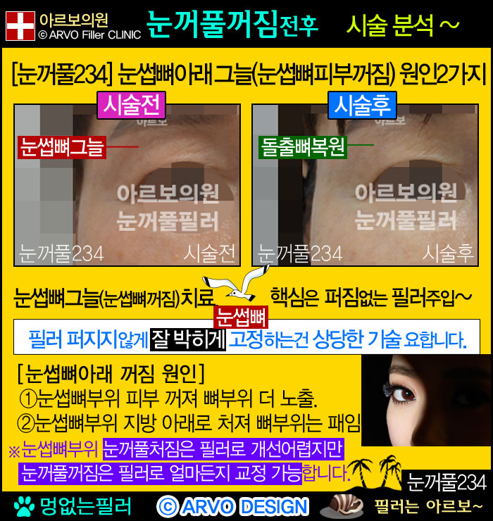 눈썹뼈필러,눈썹뼈눈꺼풀필러,눈뼈필러,아르보의원
