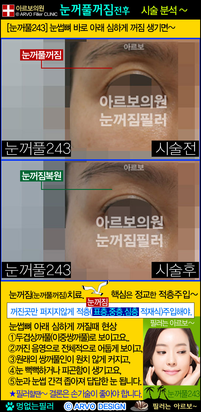 눈위필러,눈위꺼짐필러,눈꺼풀필러,눈두덩필러,좁은눈필러,눈주름필러,이중쌍꺼풀필러