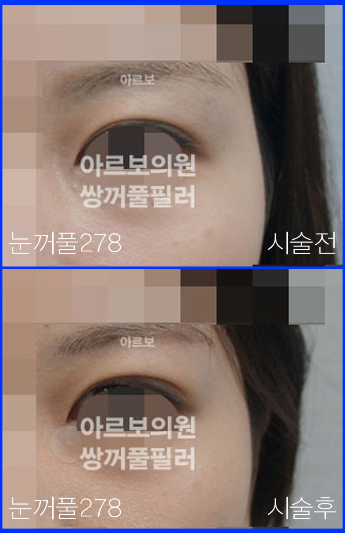 ����Ǯ�ʷ�,�Ƹ����ǿ�,�ֲ�Ǯũ��