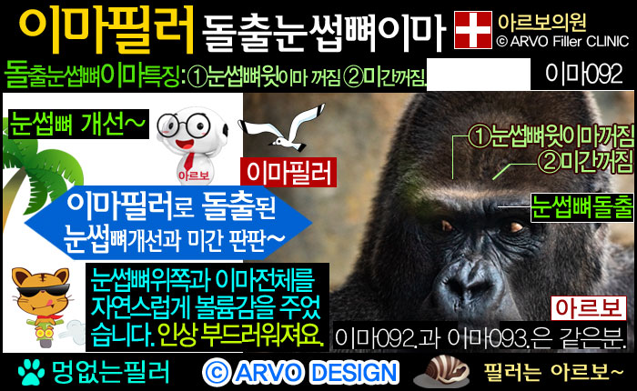 이마필러효과,이마꺼짐,미간필러,이마함몰필러,이마꺼짐필러,이마필러
