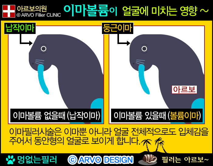 이마필러효과,이마꺼짐,이마볼륨,동안필러,이마꺼짐필러,이마필러