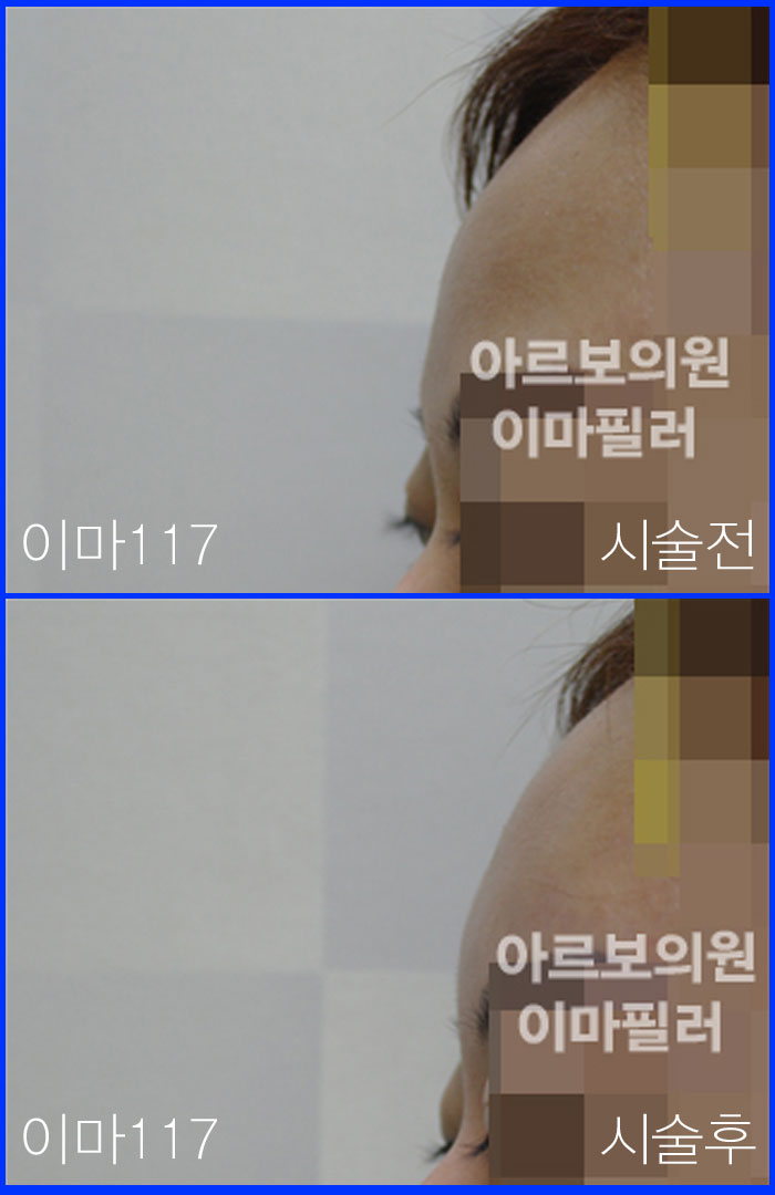 이마필러,이마꺼짐필러,꺼진이마필러,아르보의원