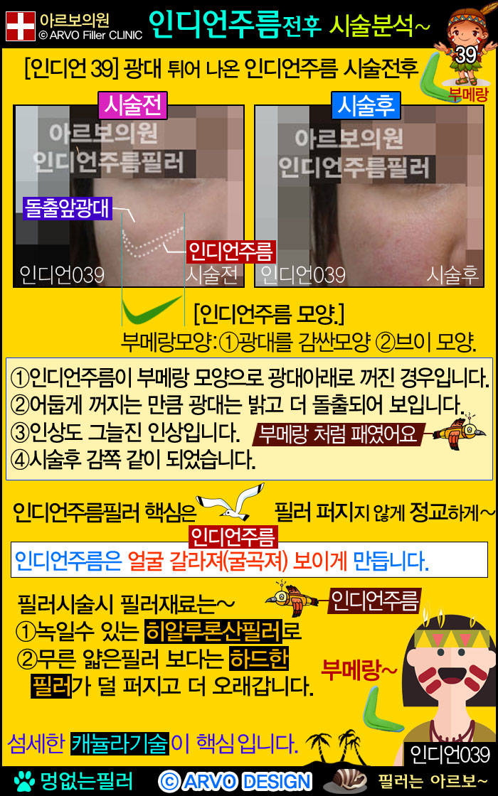 인디언주름,인디언주름필러39-2,부메랑,브메랑,브이형인디언주름,브이인디언주름
