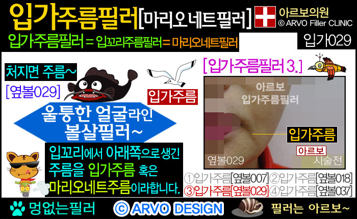 입가주름필러,입꼬리주름필러,마리오네트필러,마리오네트주름필러,마리오넷주름