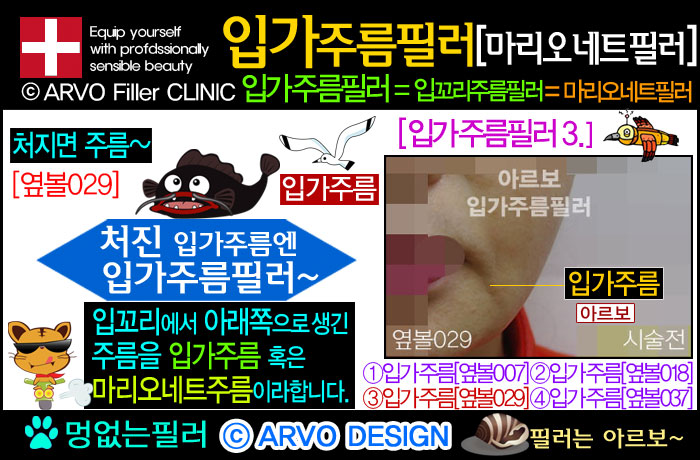 입가주름필러,입꼬리주름필러,마리오네트필러,마리오네트주름필러,마리오넷주름