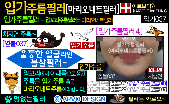 입가주름필러,입꼬리주름필러,마리오네트필러,마리오네트주름필러,마리오넷주름