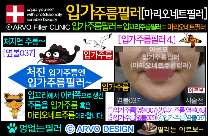 입가주름필러,입꼬리주름필러,마리오네트필러,마리오네트주름필러,마리오넷주름